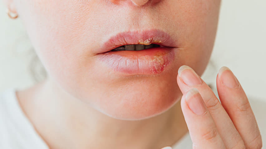 Фото - Впервые исследовано происхождение вируса герпеса на губах
