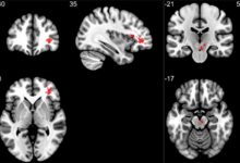 Фото - МРТ показало наличие аномалий в мозгу после COVID-19