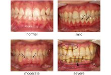 Фото - Стоматологи обнаружили, что вейпинг разрушает зубы