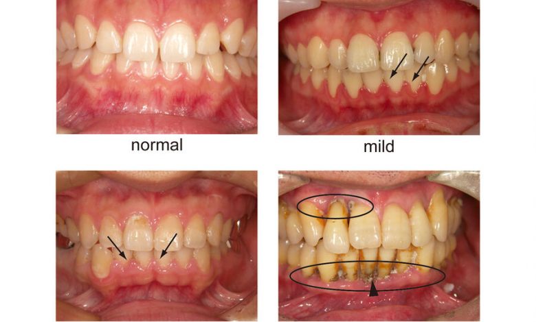 Фото - Стоматологи обнаружили, что вейпинг разрушает зубы